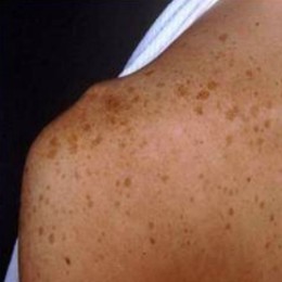 age spots